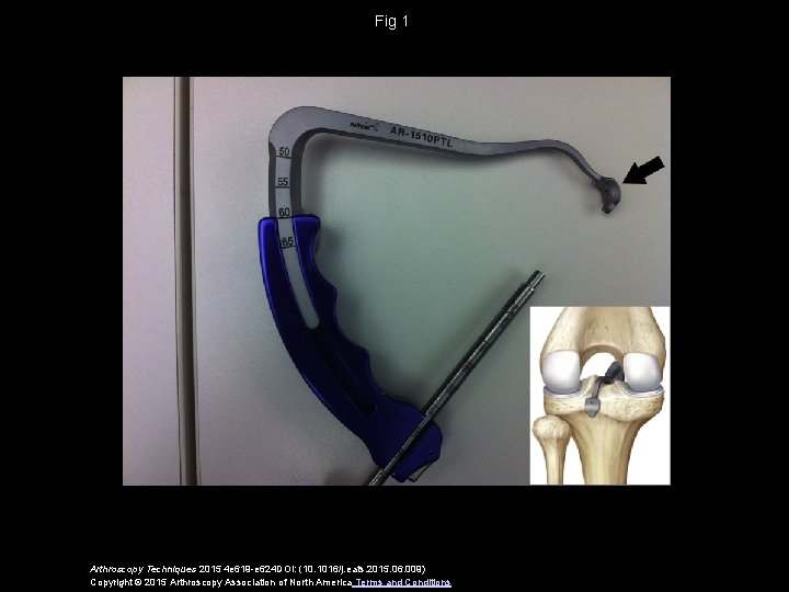 Fig 1 Arthroscopy Techniques 2015 4 e 619 -e 624 DOI: (10. 1016/j. eats.