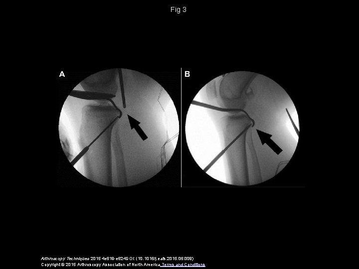 Fig 3 Arthroscopy Techniques 2015 4 e 619 -e 624 DOI: (10. 1016/j. eats.