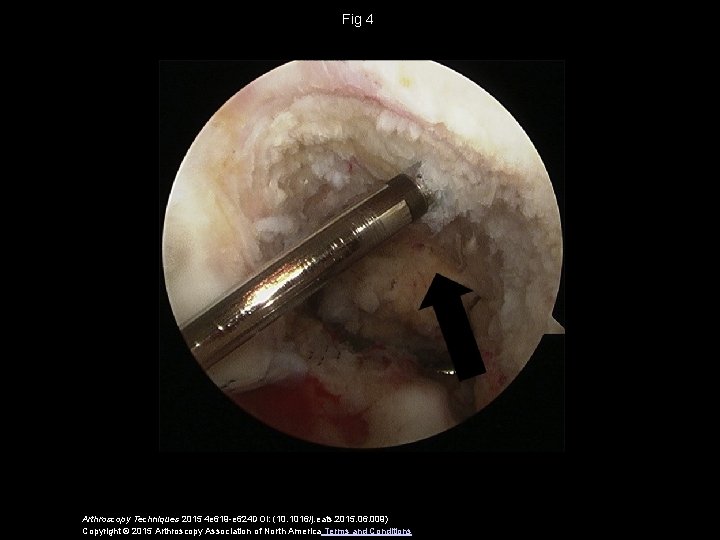Fig 4 Arthroscopy Techniques 2015 4 e 619 -e 624 DOI: (10. 1016/j. eats.