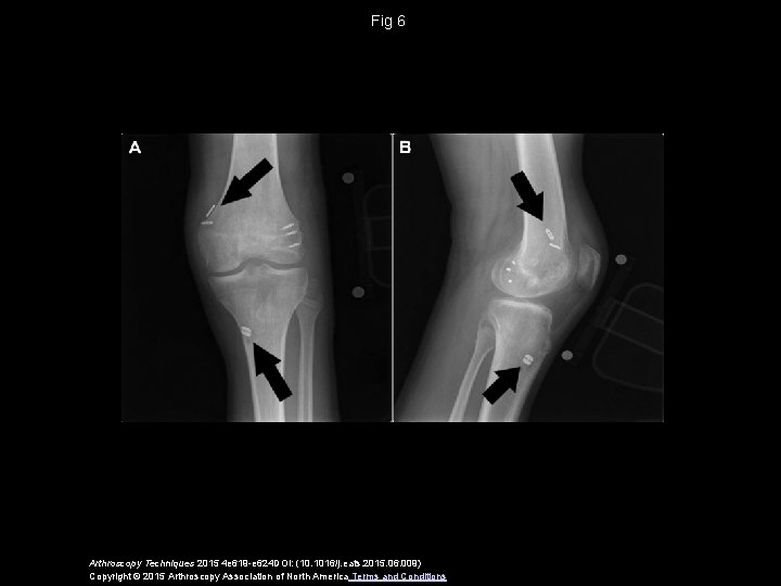 Fig 6 Arthroscopy Techniques 2015 4 e 619 -e 624 DOI: (10. 1016/j. eats.