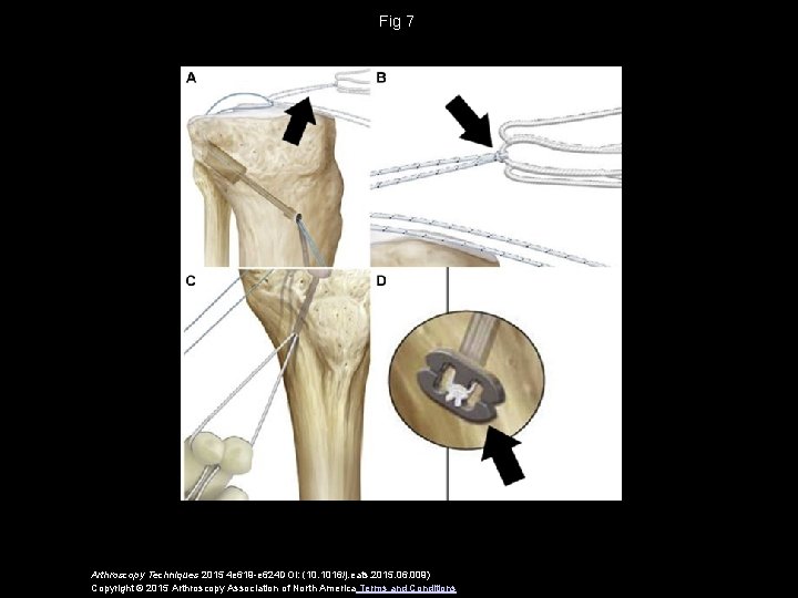 Fig 7 Arthroscopy Techniques 2015 4 e 619 -e 624 DOI: (10. 1016/j. eats.