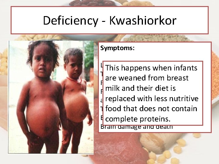 Deficiency - Kwashiorkor Symptoms: Loose. when infants This weight happens Tissues waste away. are