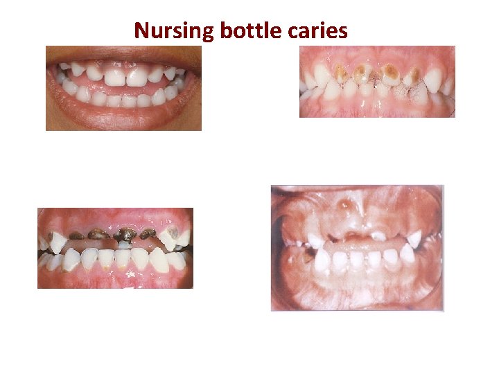 Nursing bottle caries 