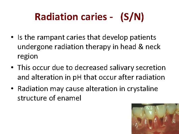 Radiation caries - (S/N) • Is the rampant caries that develop patients undergone radiation