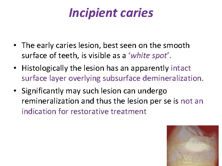 Incipient caries • The early caries lesion, best seen on the smooth surface of