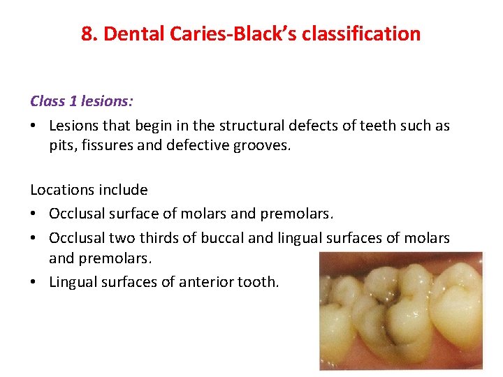 8. Dental Caries-Black’s classification Class 1 lesions: • Lesions that begin in the structural