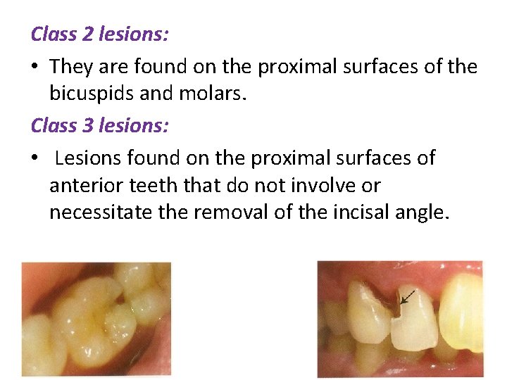 Class 2 lesions: • They are found on the proximal surfaces of the bicuspids