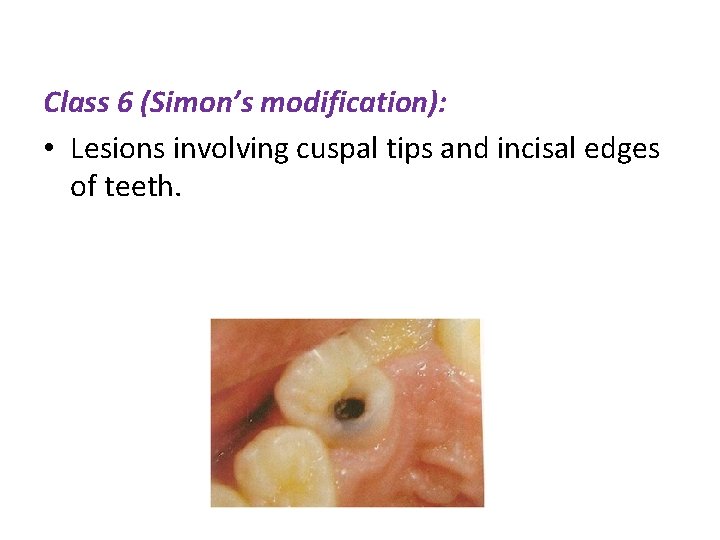 Class 6 (Simon’s modification): • Lesions involving cuspal tips and incisal edges of teeth.