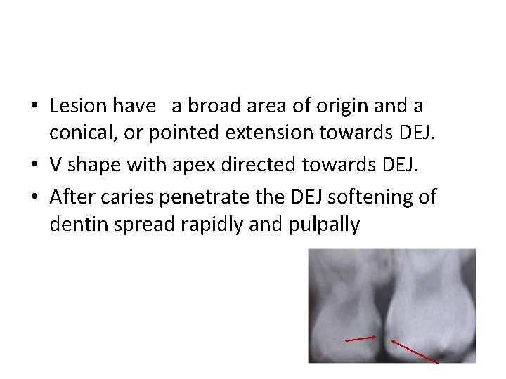  • Lesion have a broad area of origin and a conical, or pointed