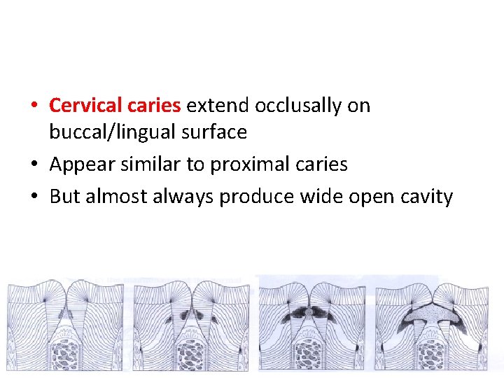  • Cervical caries extend occlusally on buccal/lingual surface • Appear similar to proximal