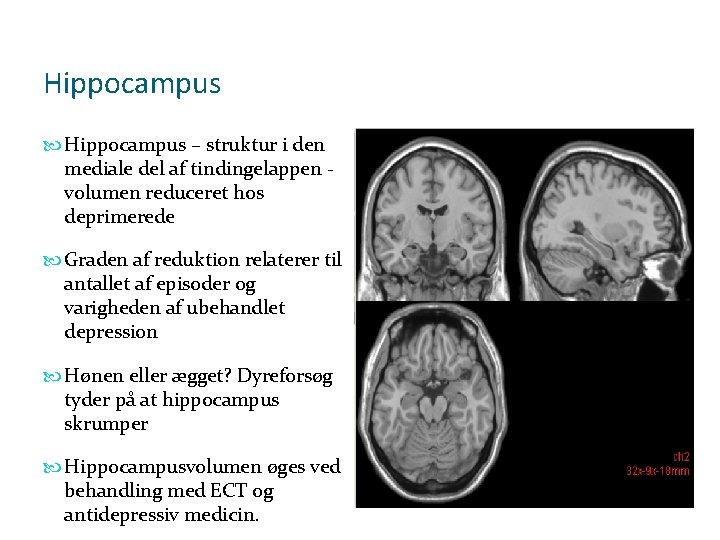 Hippocampus – struktur i den mediale del af tindingelappen volumen reduceret hos deprimerede Graden