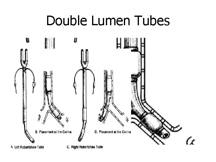 Double Lumen Tubes 