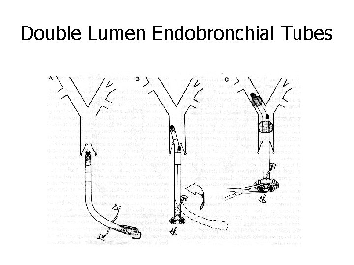 Double Lumen Endobronchial Tubes 