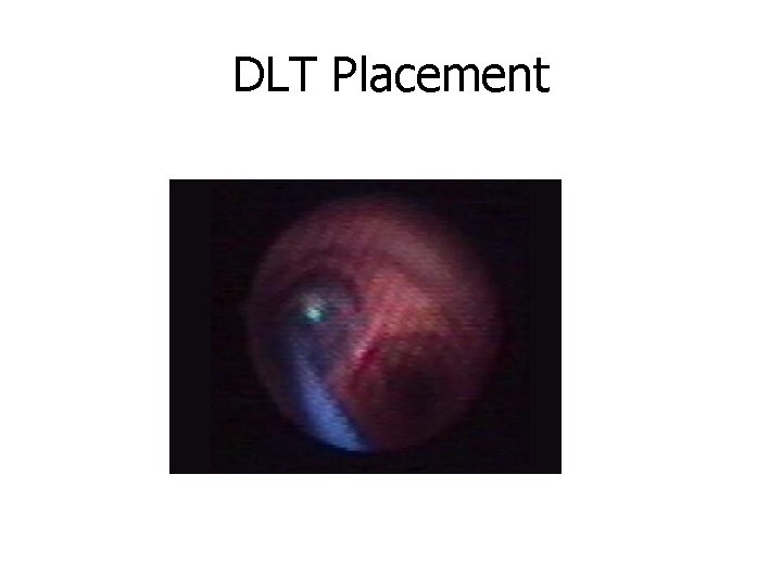 DLT Placement 