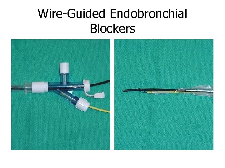 Wire-Guided Endobronchial Blockers 