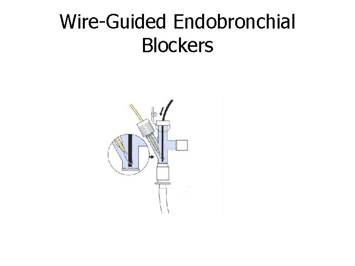 Wire-Guided Endobronchial Blockers 