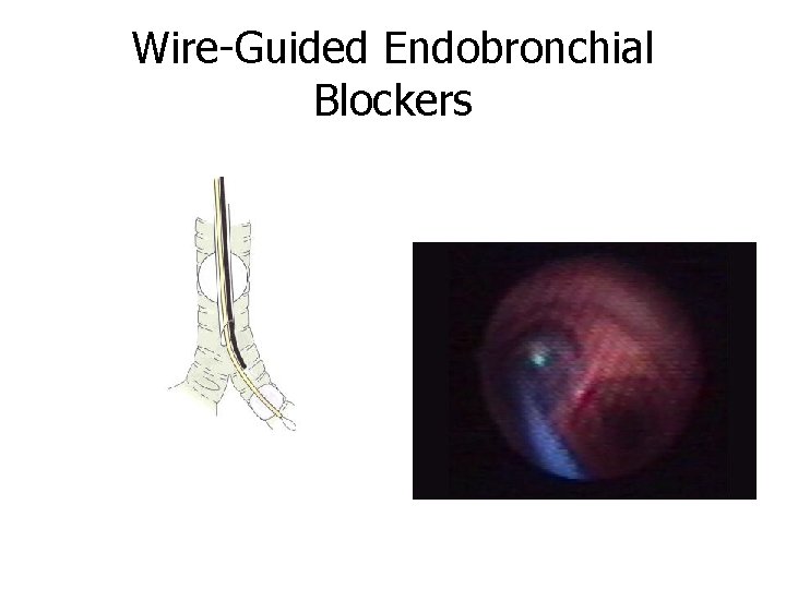 Wire-Guided Endobronchial Blockers 