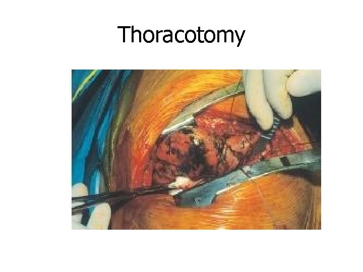 Thoracotomy 