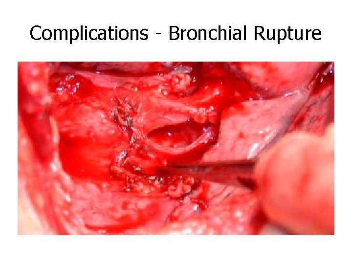 Complications - Bronchial Rupture 