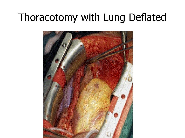 Thoracotomy with Lung Deflated 