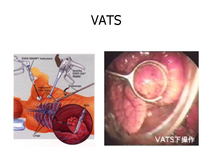 VATS 