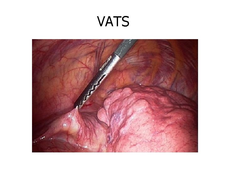 VATS 