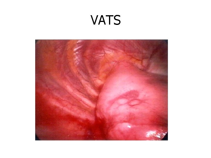 VATS 