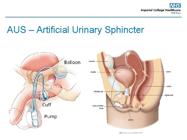 AUS – Artificial Urinary Sphincter 