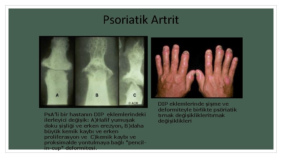 Psoriatik Artrit Ps. A’li bir hastanın DIP eklemlerindeki ilerleyici değişik: A)Hafif yumuşak doku şişliği