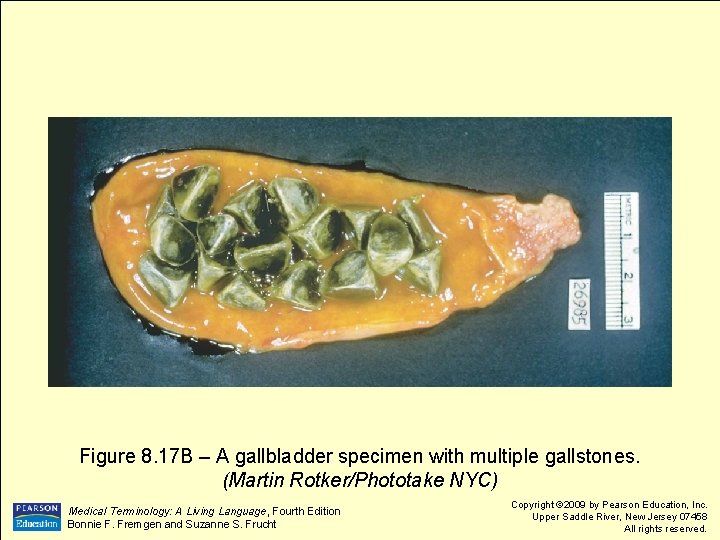 Figure 8. 17 B – A gallbladder specimen with multiple gallstones. (Martin Rotker/Phototake NYC)