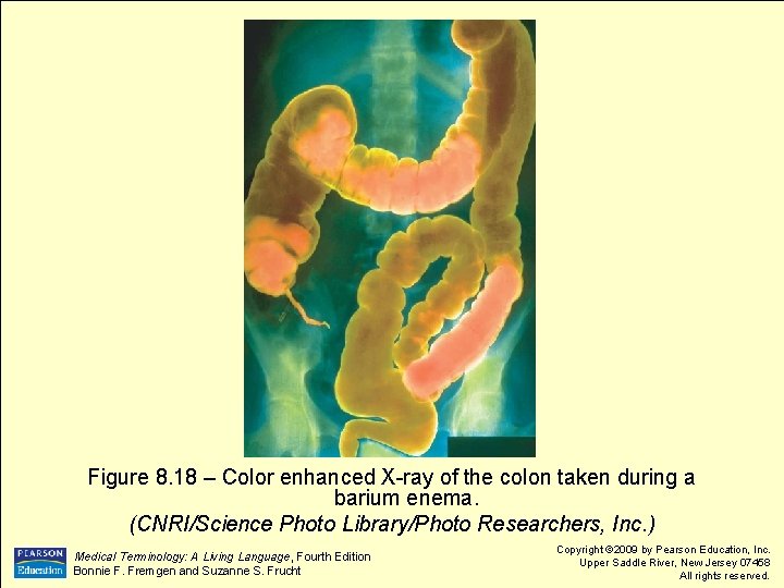 Figure 8. 18 – Color enhanced X-ray of the colon taken during a barium