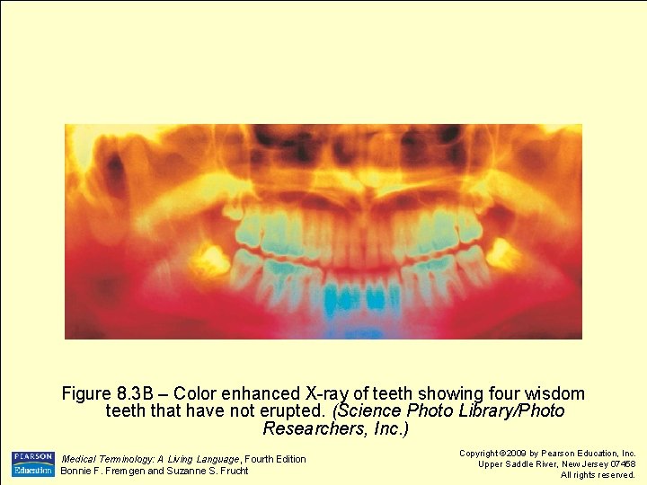 Figure 8. 3 B – Color enhanced X-ray of teeth showing four wisdom teeth Figure 8. 3 B – Color enhanced X-ray of teeth showing four wisdom teeth