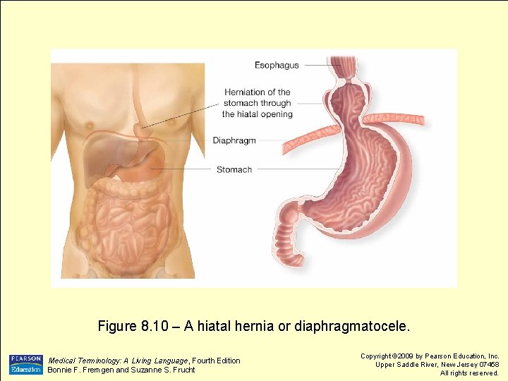 Figure 8. 10 – A hiatal hernia or diaphragmatocele. Medical Terminology: A Living Language,