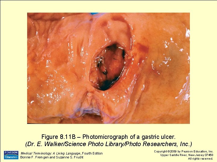 Figure 8. 11 B – Photomicrograph of a gastric ulcer. (Dr. E. Walker/Science Photo