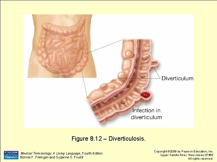 Figure 8. 12 – Diverticulosis. Medical Terminology: A Living Language, Fourth Edition Bonnie F.