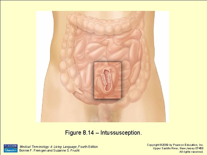 Figure 8. 14 – Intussusception. Medical Terminology: A Living Language, Fourth Edition Bonnie F.