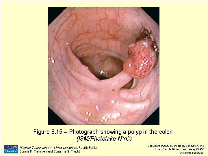 Figure 8. 15 – Photograph showing a polyp in the colon. (ISM/Phototake NYC) Medical Figure 8. 15 – Photograph showing a polyp in the colon. (ISM/Phototake NYC) Medical