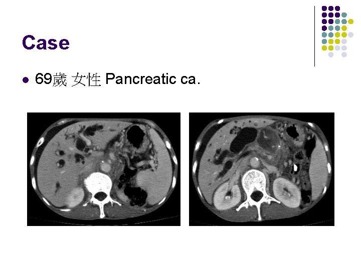 Case l 69歲 女性 Pancreatic ca. 