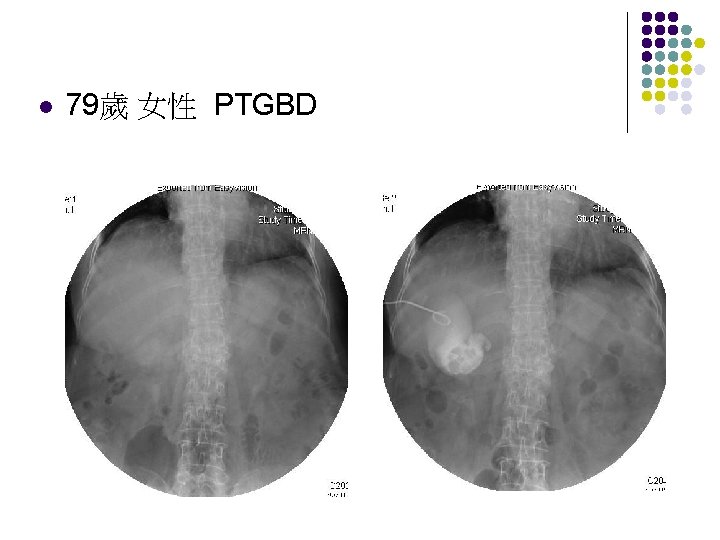 l 79歲 女性 PTGBD 