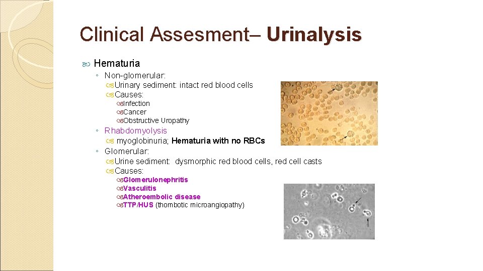 Clinical Assesment– Urinalysis Hematuria ◦ Non-glomerular: Urinary sediment: intact red blood cells Causes: Infection