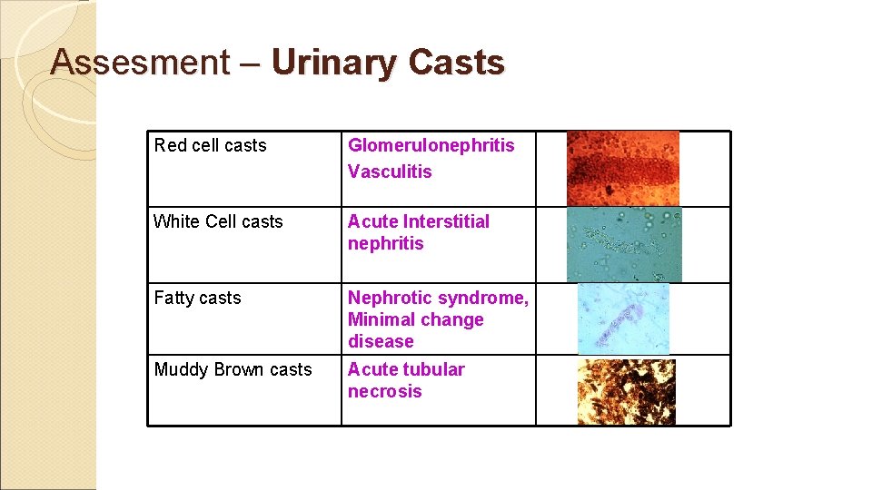 Assesment – Urinary Casts Red cell casts Glomerulonephritis Vasculitis White Cell casts Acute Interstitial