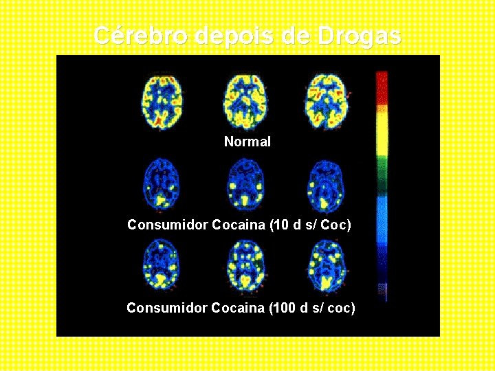 Cérebro depois de Drogas Normal Consumidor Cocaina (10 d s/ Coc) Consumidor Cocaina (100