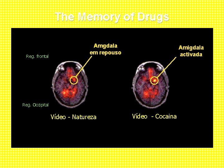 The Memory of Drugs Front Brain Reg. of frontal Amgdala em repouso Amigdala activada