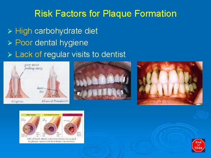 Risk Factors for Plaque Formation High carbohydrate diet Ø Poor dental hygiene Ø Lack