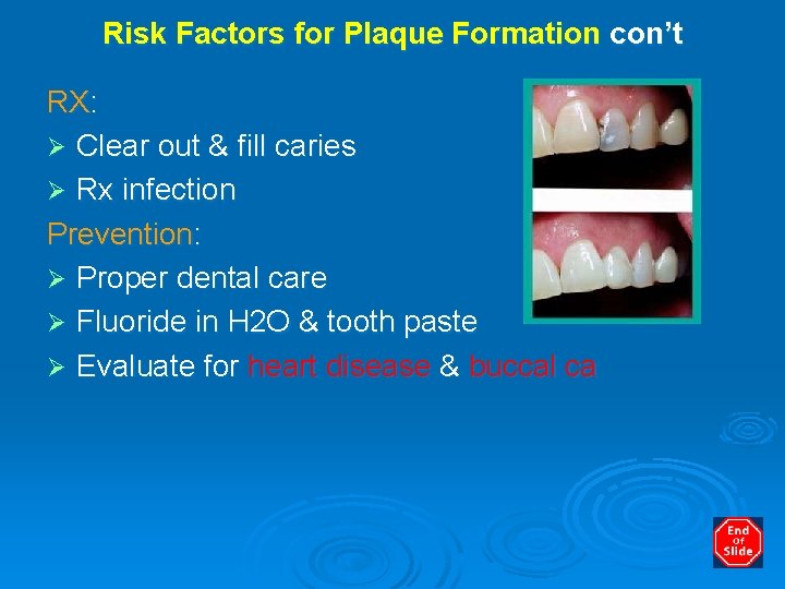 Risk Factors for Plaque Formation con’t RX: Ø Clear out & fill caries Ø