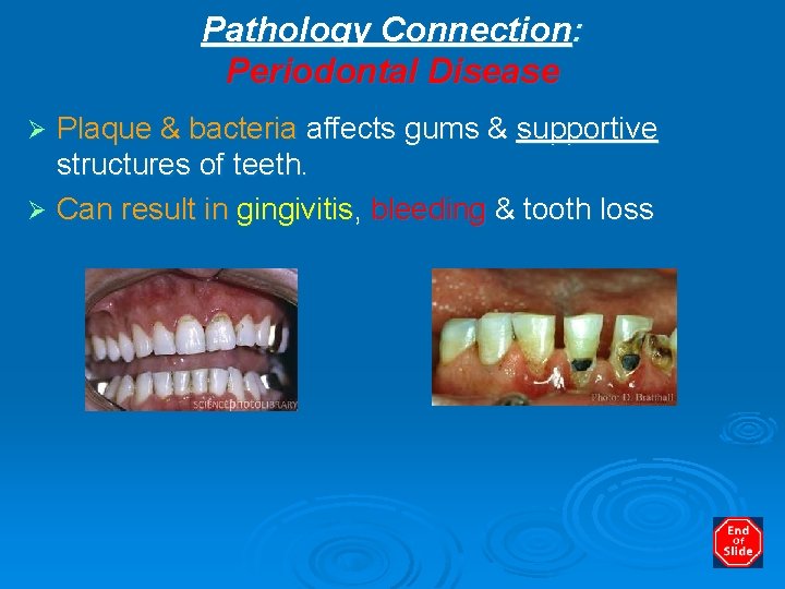 Pathology Connection: Periodontal Disease Plaque & bacteria affects gums & supportive structures of teeth.