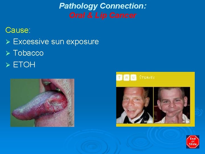 Pathology Connection: Oral & Lip Cancer Cause: Ø Excessive sun exposure Ø Tobacco Ø