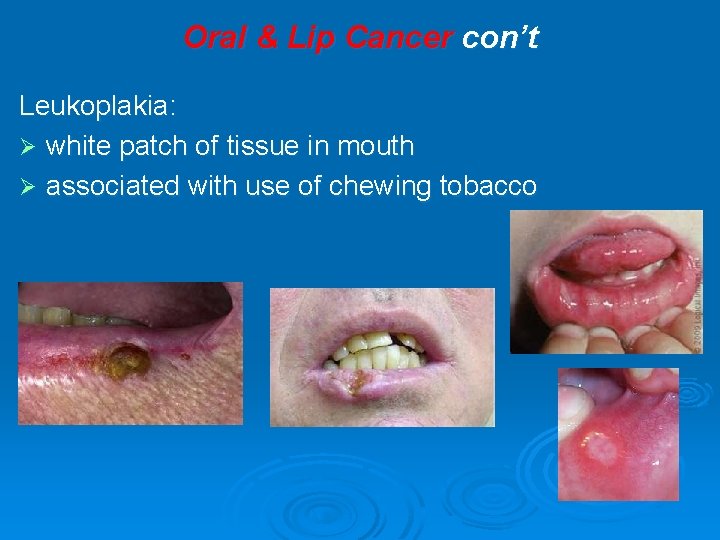 Oral & Lip Cancer con’t Leukoplakia: Ø white patch of tissue in mouth Ø