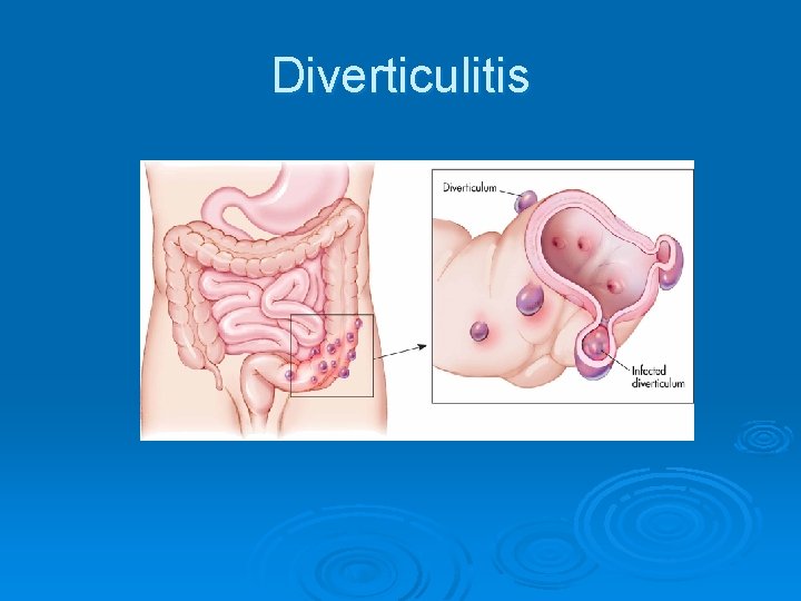 Diverticulitis 