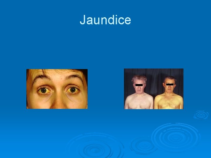 Jaundice 